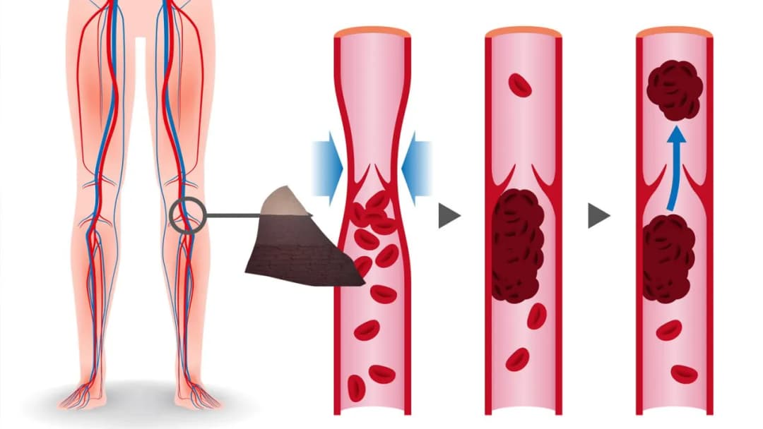 Zaburzenia krzepnięcia krwi objawy - jak je rozpoznać i leczyć
